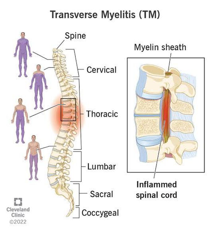 Transverse Myelitis Medizzy