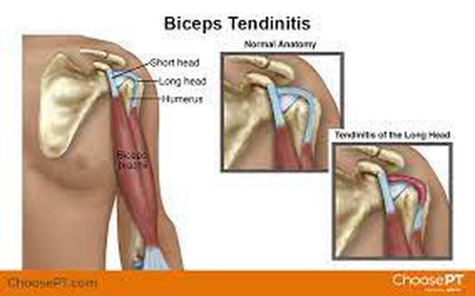 How Is Biceps Tendonitis Treated MEDizzy