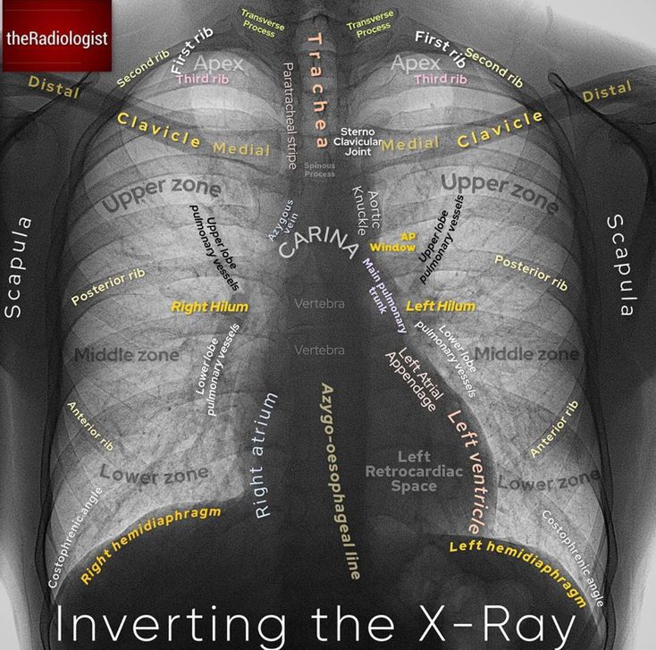 Normal CXR MEDizzy