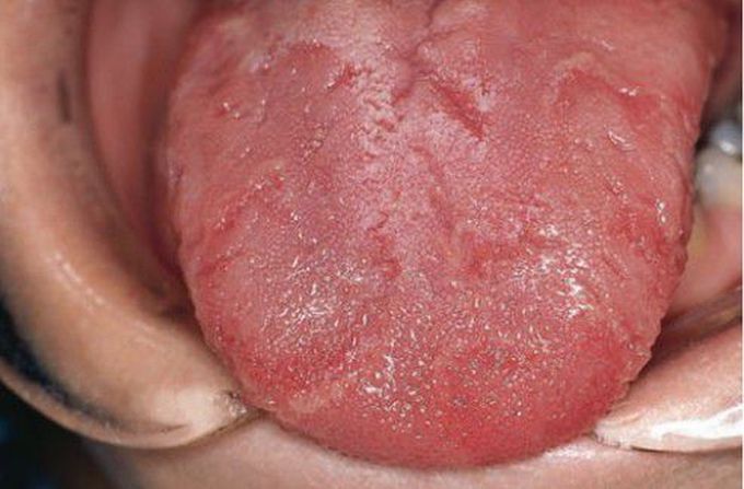 Geographic Tongue Medizzy