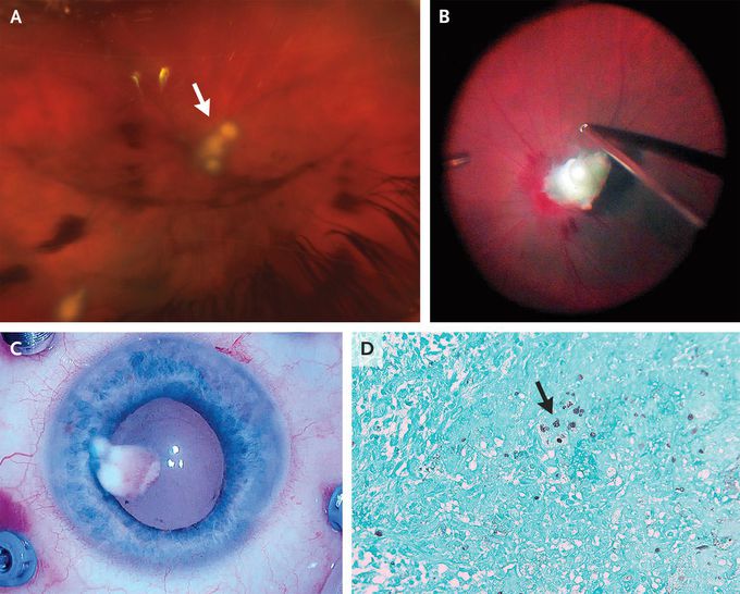 Fungal Endophthalmitis MEDizzy