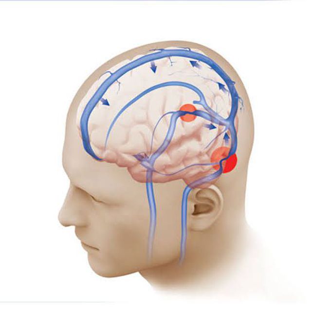 Causes Of Pseudotumor Cerebri MEDizzy