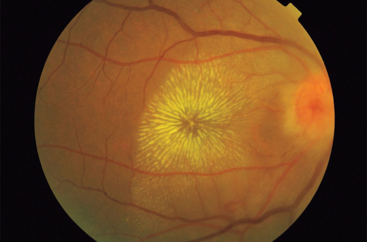 Bartonella Neuroretinitis Medizzy