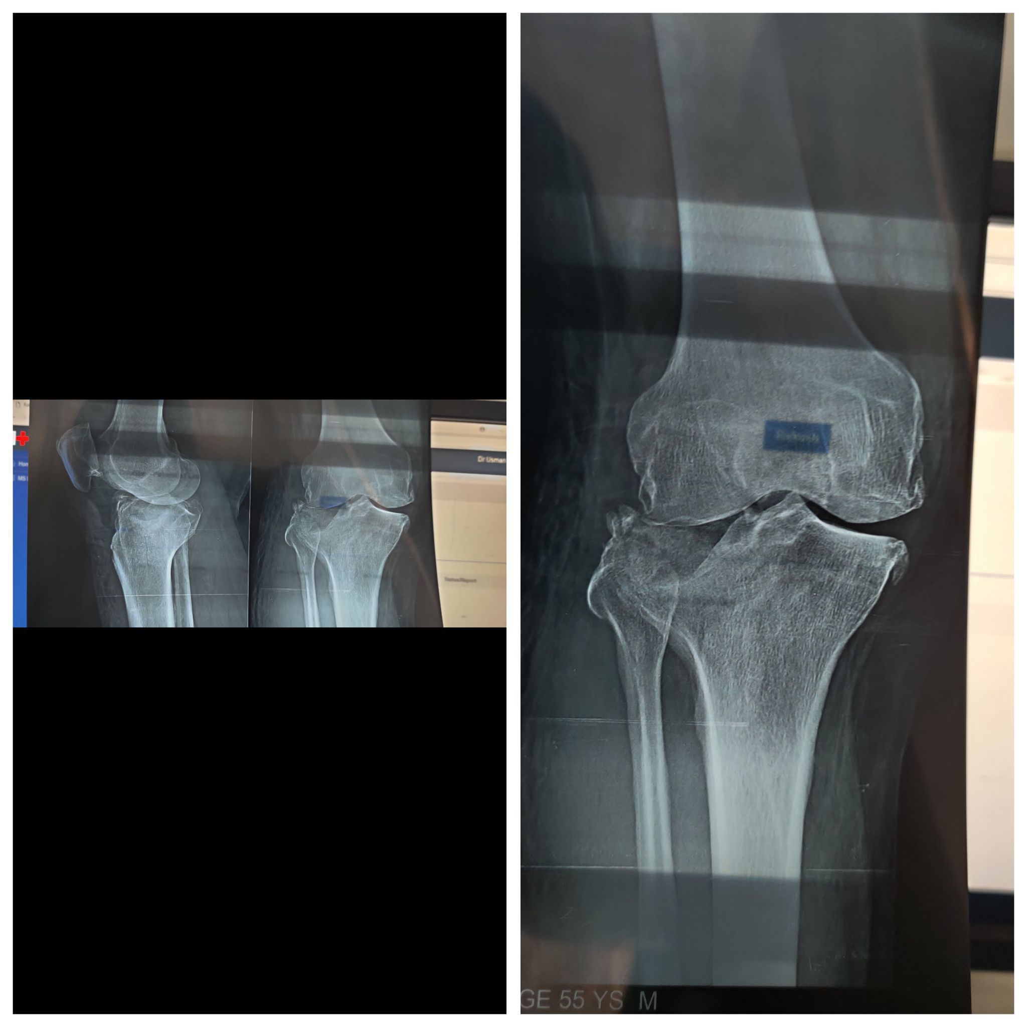 Tibia Fracture MEDizzy