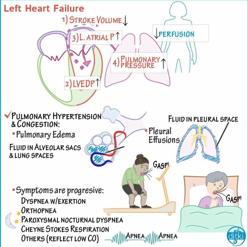 Left Heart Failure Medizzy