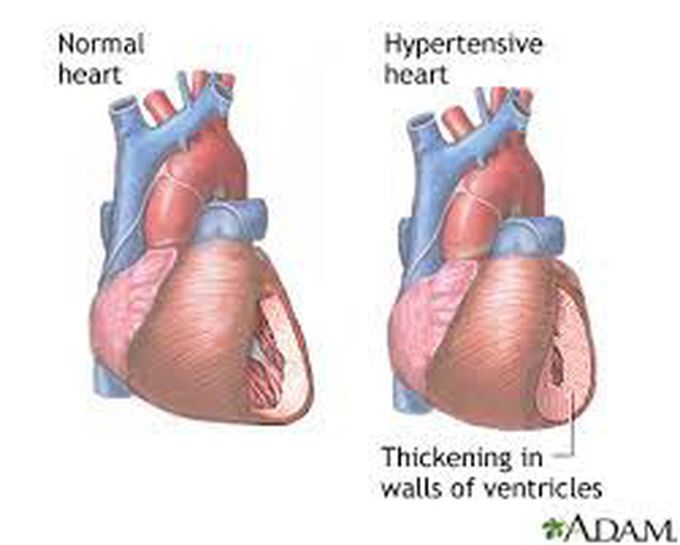 Causes Of Hypertension MEDizzy