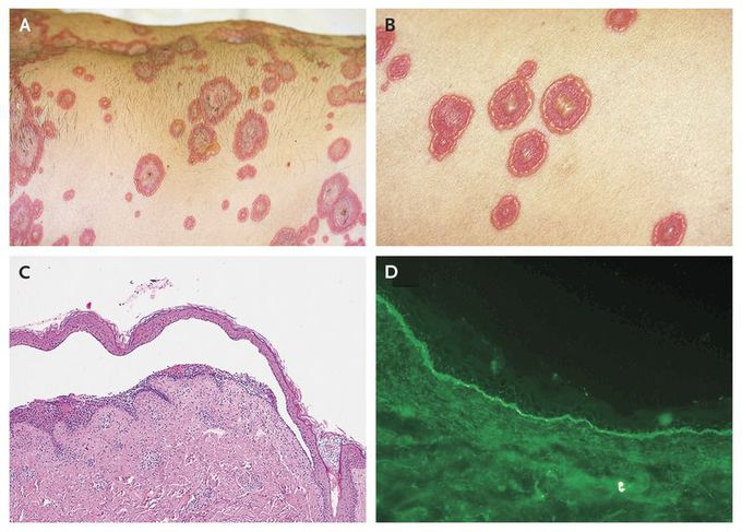 Linear IgA Bullous Disease MEDizzy