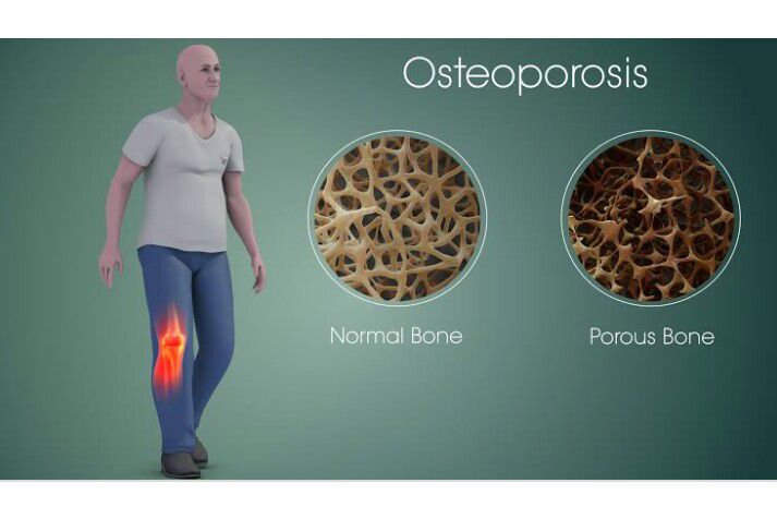 Osteoporosis Medizzy