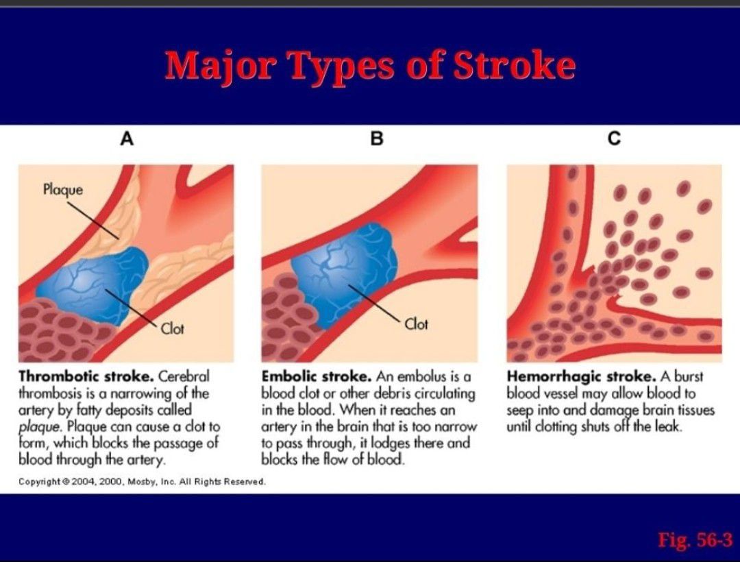 Stroke MEDizzy