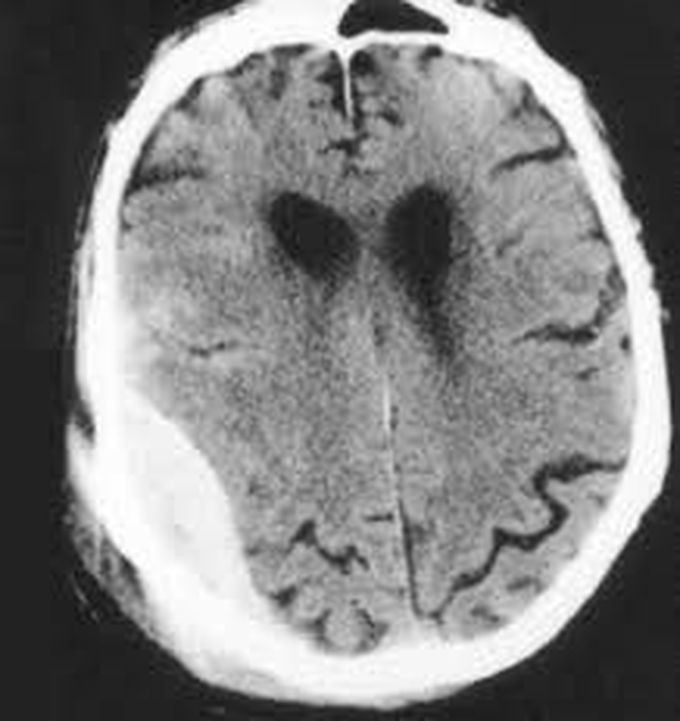 Cause Of Epidural Hematoma Medizzy