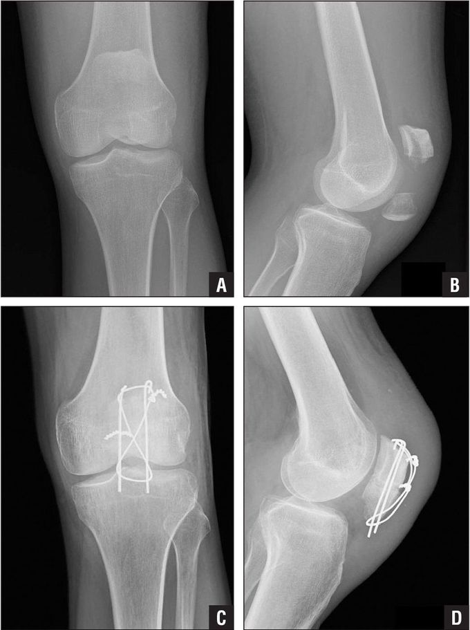 Fractured Patella Plus Repairment MEDizzy