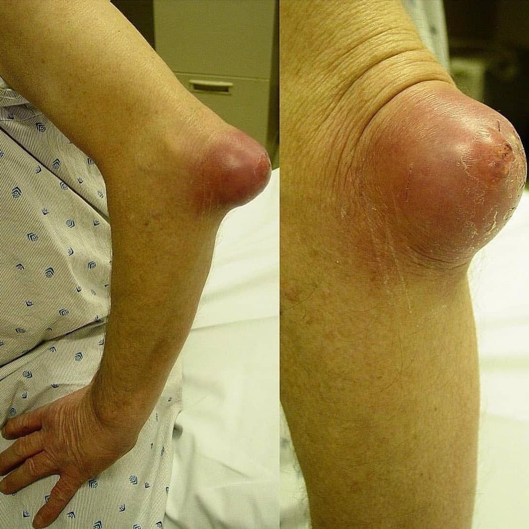 Acute Infectious Olecranon Bursitis Upon Presentation To The Medizzy