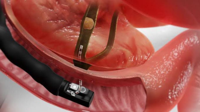 Endoscopic Retrograde Cholangiopancreatography ERCP MEDizzy