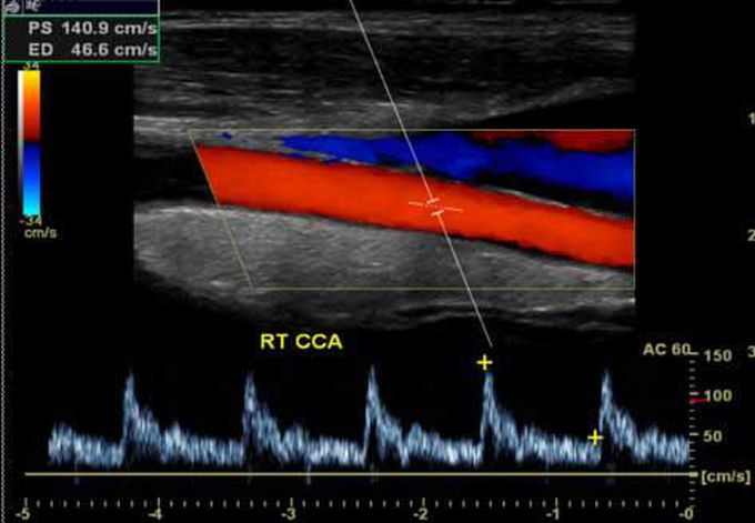 Carotid Ultrasound Test