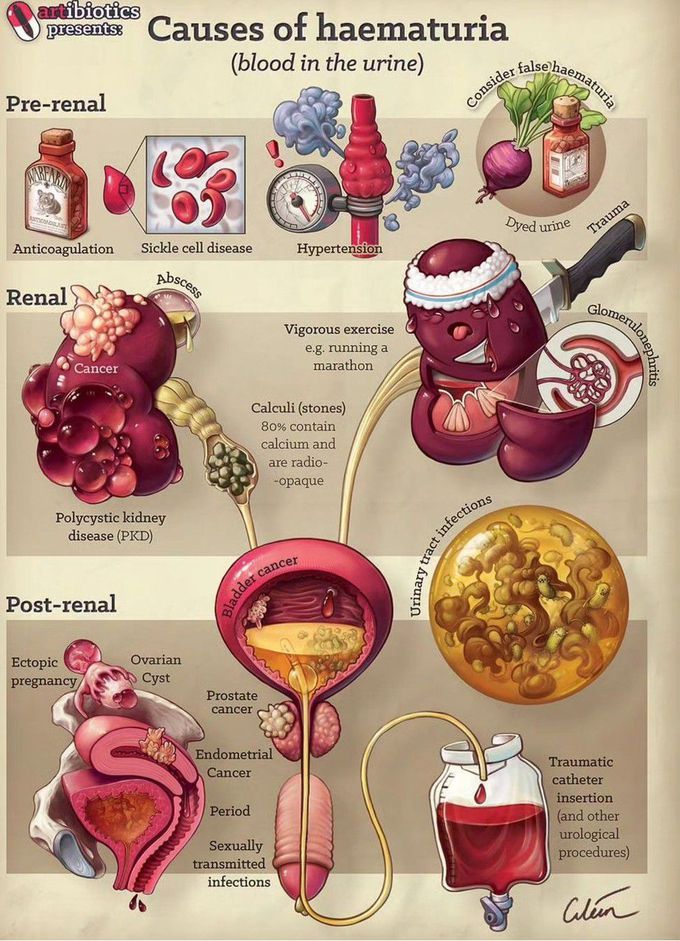 Causes of Hematuria