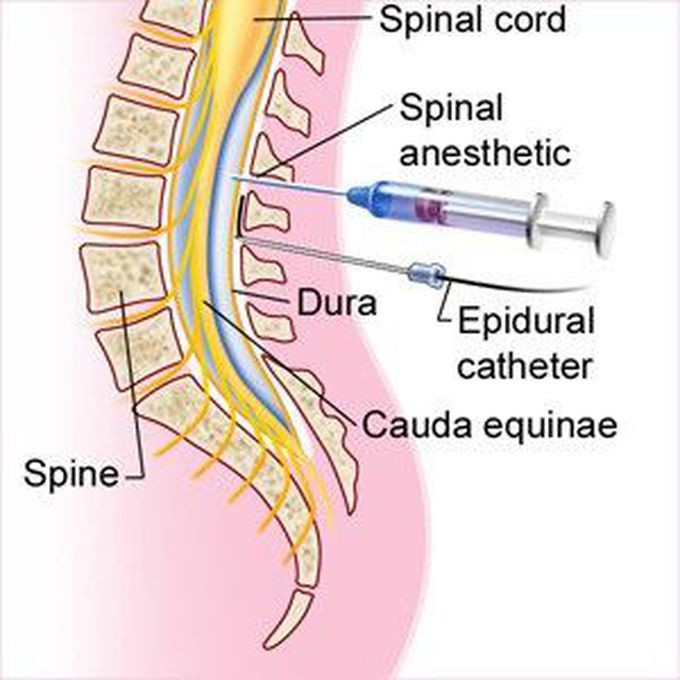 Types of spinal anesthesia