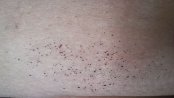 Dermatology