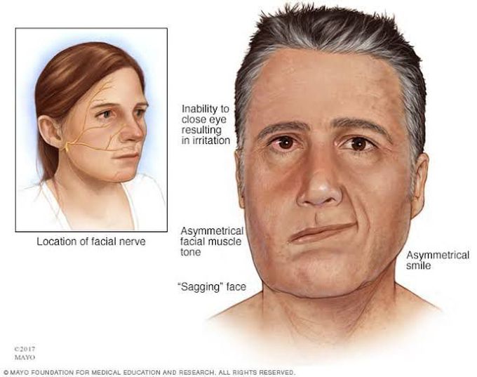 Bell's palsy