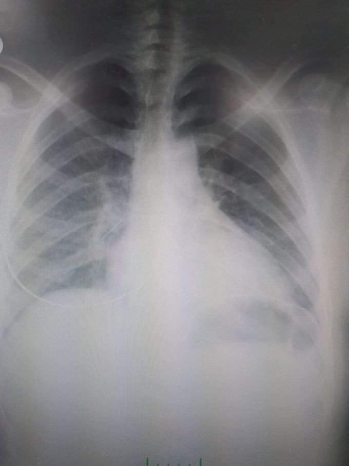 She swallowed a needle.