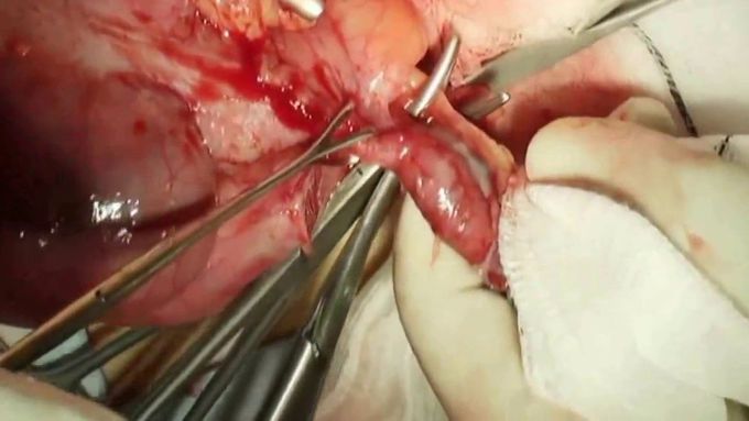 Appendicectomy Procedure