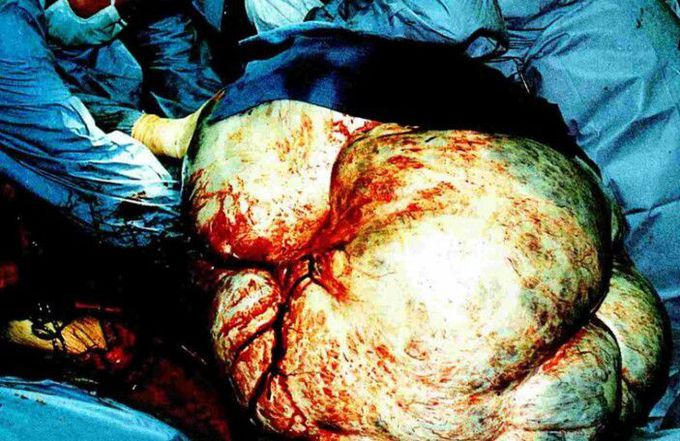 Largest tumour ever removed