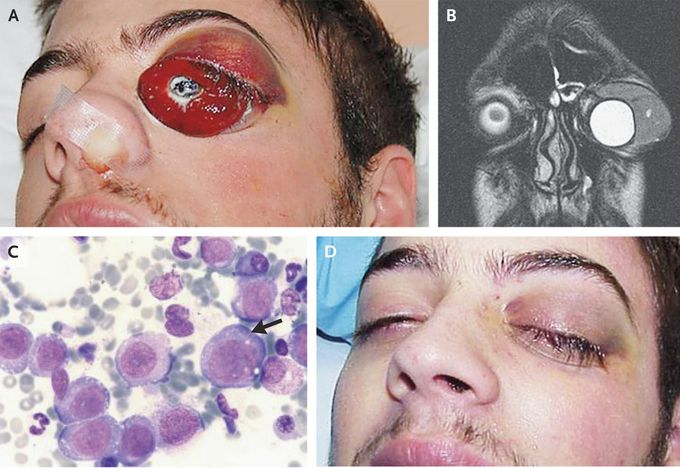 Myeloid Sarcoma