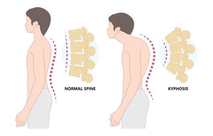 Kyphosis