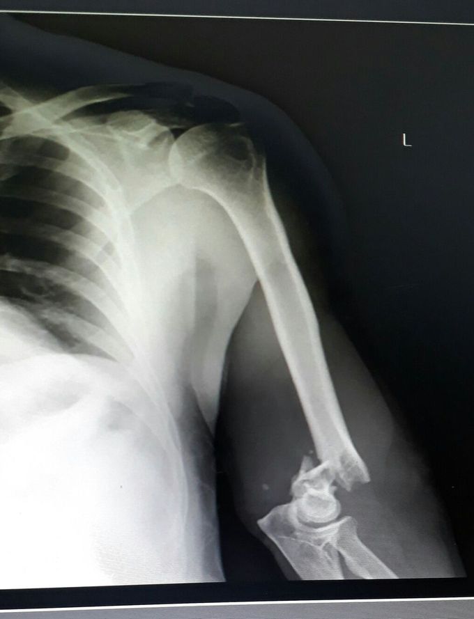 Humerus fracture !