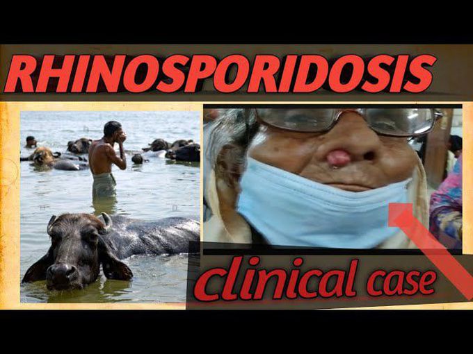 RHINOSPORIODOSIS - CHRONIC GRANULOMATOUS  DISEASE  - RARE CLINICAL CASE STUDY