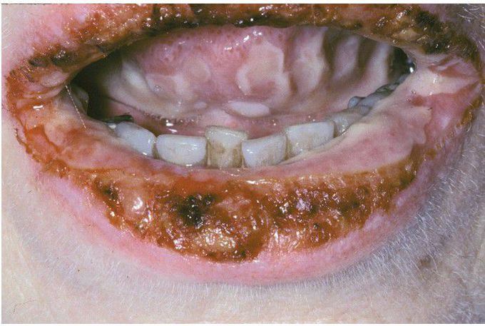 Paraneoplastic Pemphigus.