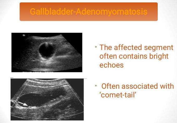 Adenomyomatosis