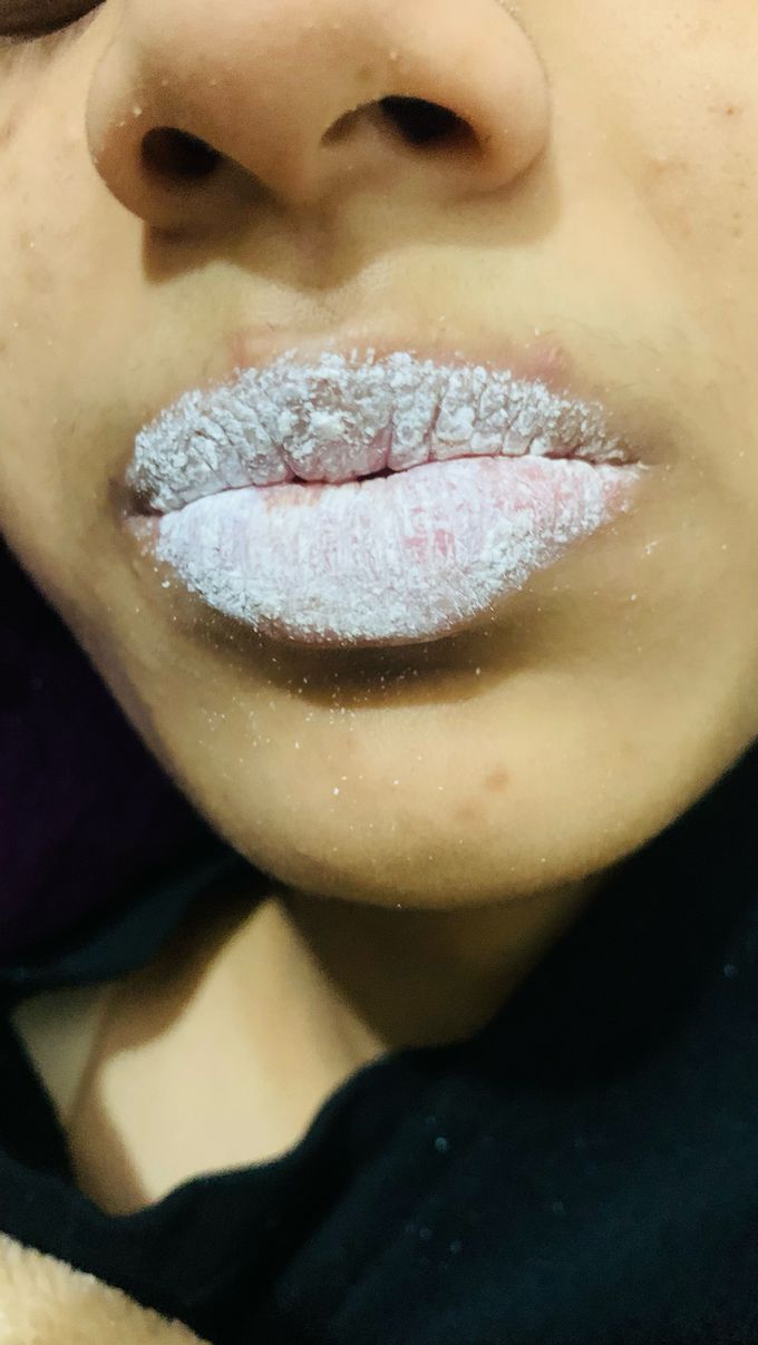 White powder discharge from lips