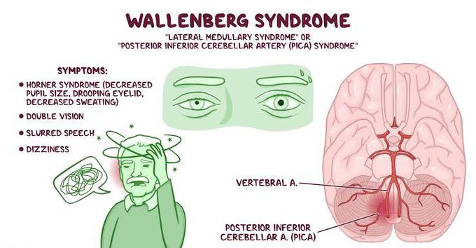 These are the symptoms of Wallenberg syndrome