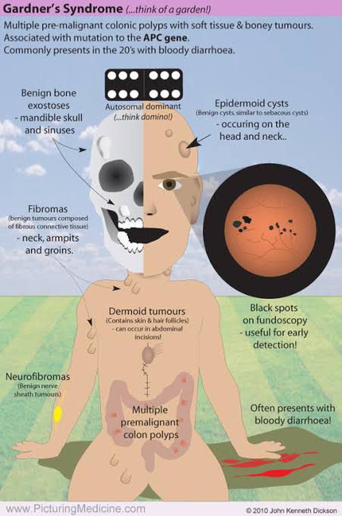 Gardner Syndrome