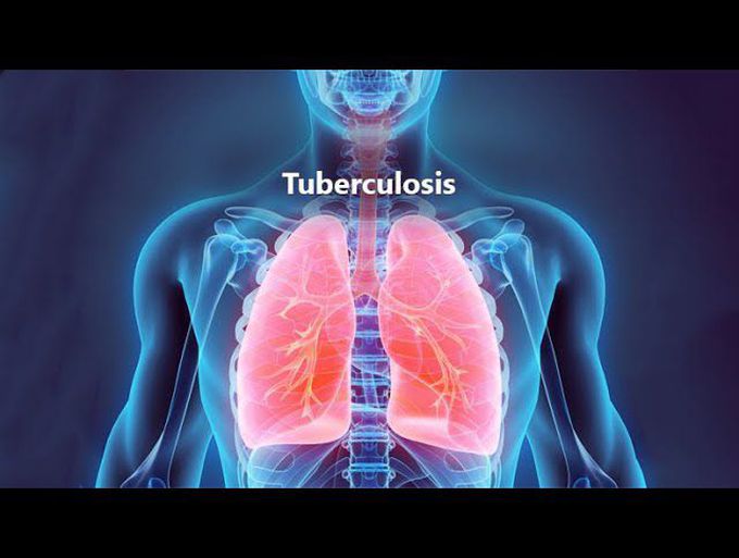 Diagnostic algorithm for Pulmonary TB in 2 minutes park psm 25th edition