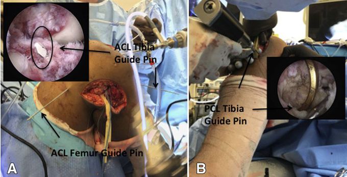 Intraoperative and correlating arthroscopic images of right knee. (A, B) Guide pins placed to planned tunnel locations: (A) anterior cruciate ligament tibial tunnel pin placement and (B) posterior cruciate ligament tibial tunnel under direct visualization through posteromedial portal. 