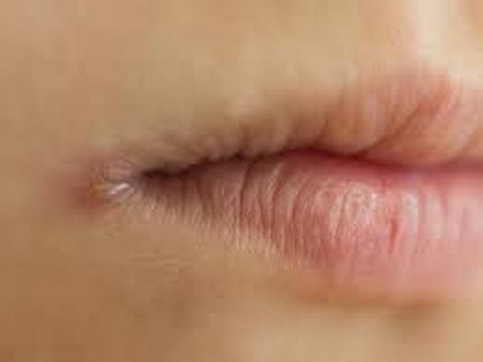 Angular cheilitis