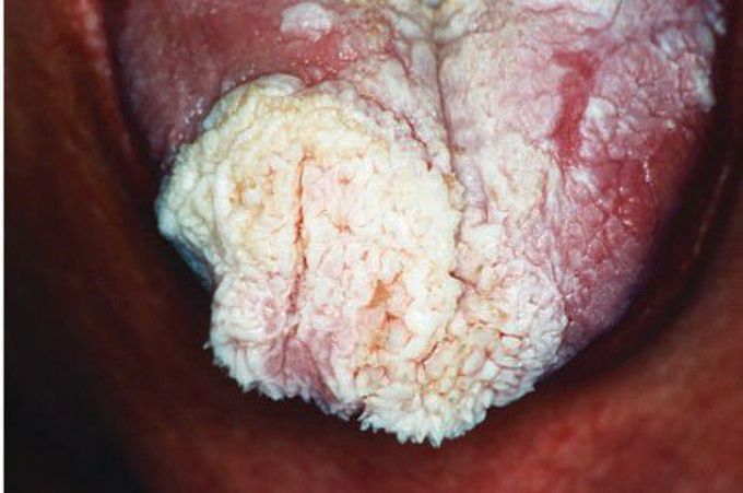Verrucous carcinoma (Tongue)
