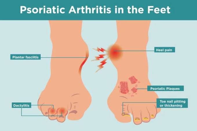 Psoriatic Arthritis