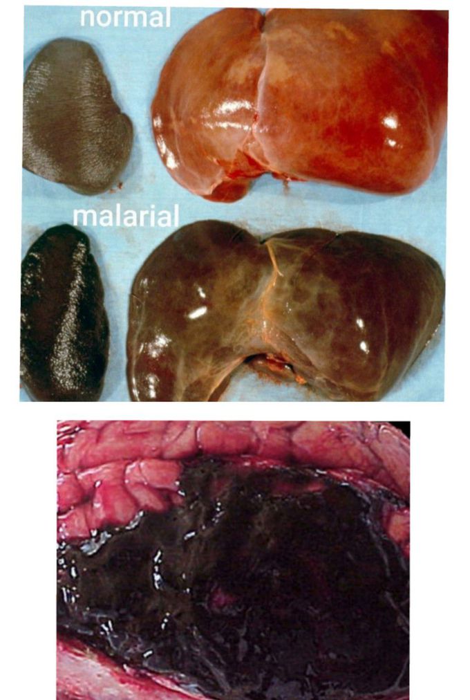 Malaria