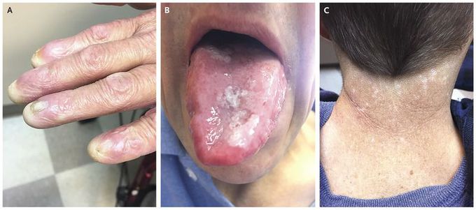 Dyskeratosis Congenita