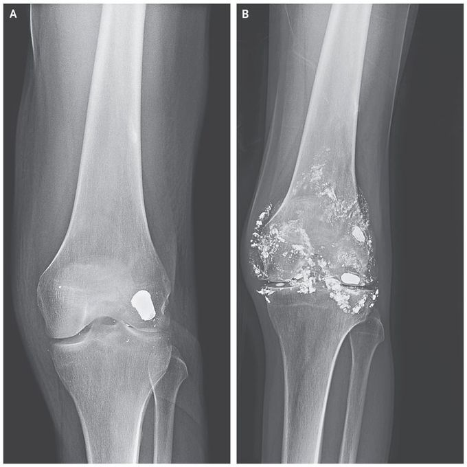 Lead Toxicity from a Retained Bullet