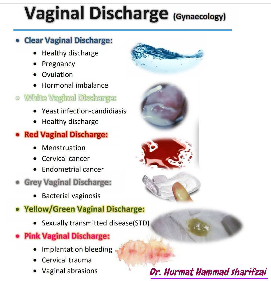 Vaginal Discharge Gynecology Medizzy 5387