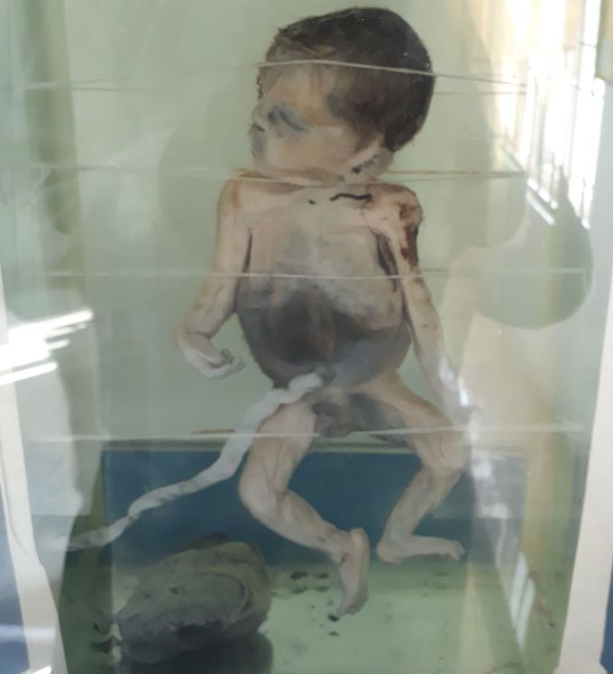Guess the age of this foetus