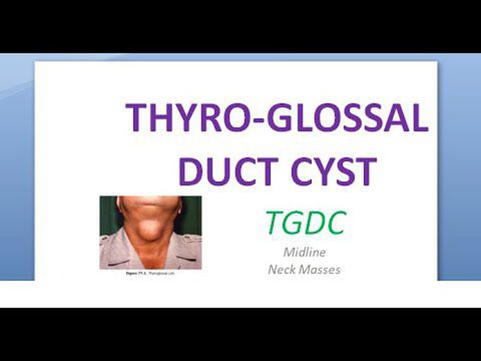 Thyroglossal Duct Cyst: Overview