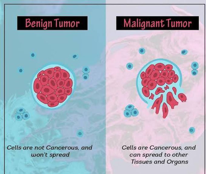 Tumor - MEDizzy