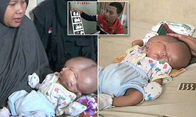 Baby born with TWO FACES and two brains but one head
