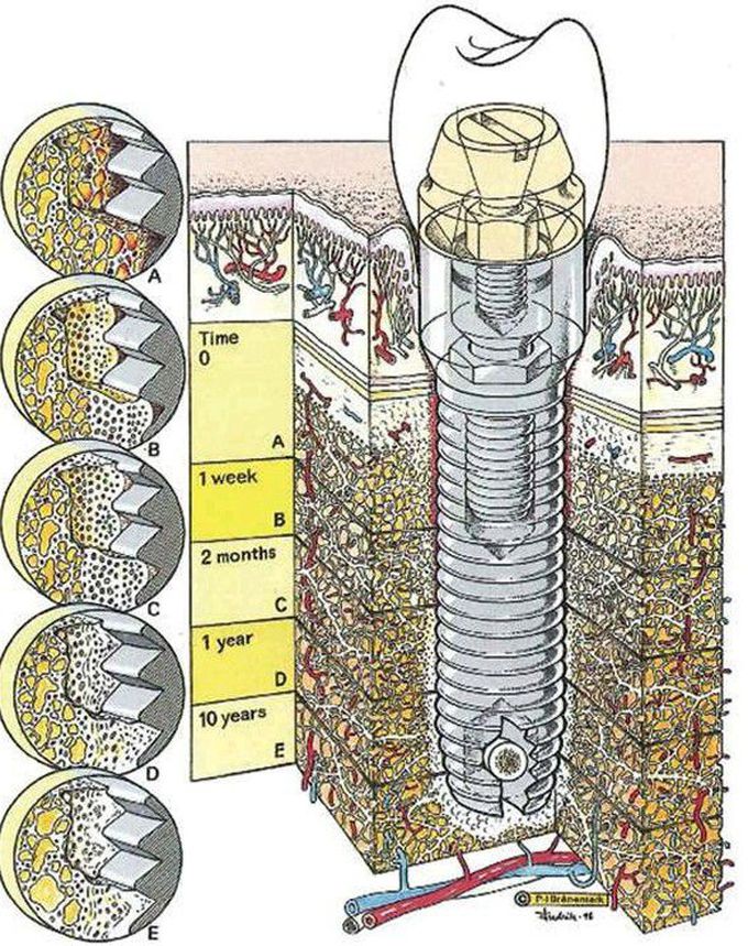 Dental implant