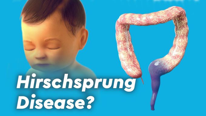Hirschsprung Disease-Neurocristopathies