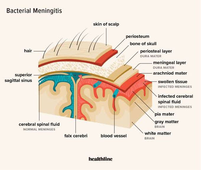 Is meningitis contagious?